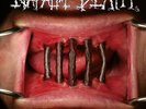 NAPALM DEATH - Coded Smears And More Uncommon Slurs ltd.Gatefold DLP RED NEUWARE