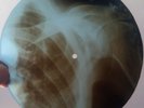 ELVIS PRESLEY - PARALYZED - UNIQUE USSR X-RAY ROENTGEN RIBS ARM BONES RECORD