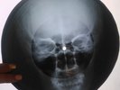 Louis Armstrong - What A Wonderful World X-RAY USSR ROENTGEN Bones Record Skull