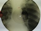 X-Ray 78rpm LECUONA CUBAN BOYS Rumba USSR ROENTGEN BONES Ribs Thorax ORIG 1950s