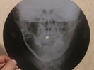 CHUCK BERRY - ROLL OVER BEETHOVEN - USSR GEORGIAN X-RAY ROENTGEN SKULL RECORD