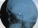 ELVIS PRESLEY - LITTLE SISTER - UNIQUE USSR GEORGIAN X-RAY ROENTGEN SKULL RECORD