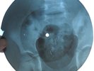 CREEDENCE CLEARWATER REVIVAL - FORTUNATE SON -GEORGIAN UNIQUE X-RAY BONES RECORD