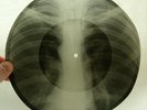X-RAY 78rpm MOONLIT NIGHT Russian Chanson USSR ROENTGEN Ribs Thorax BONES 1950s