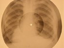 78 rpm X-RAY USSR ROENTGEN BONES RECORD ORIGINAL OLD RIBS 623