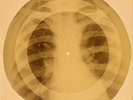 X-RAY USSR ROENTGEN BONES RECORD 78 rpm ORIGINAL OLD RIBS 725